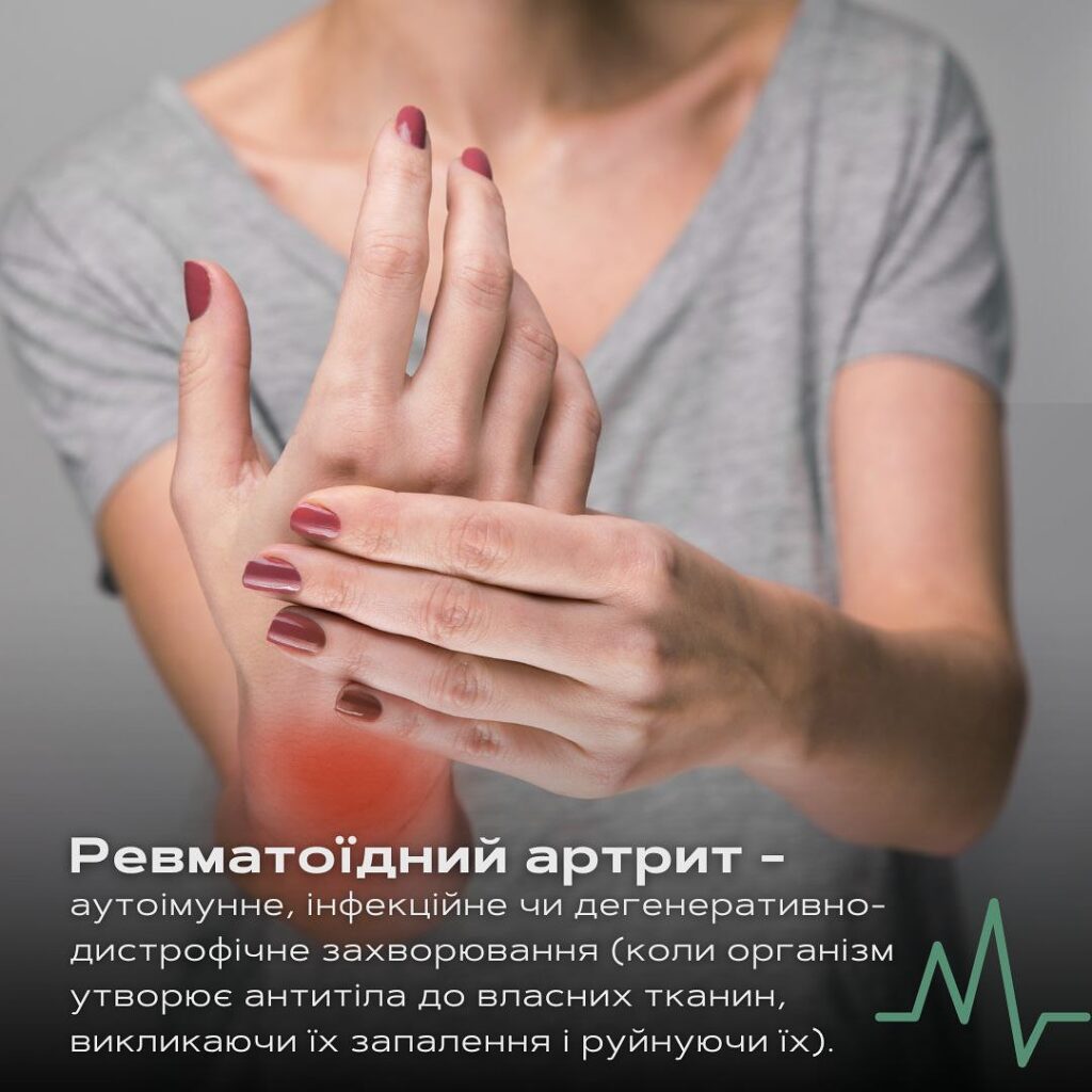 Ревматоїдний артрит - Ревматолог - Медичний центр "Лінія здоров'я"