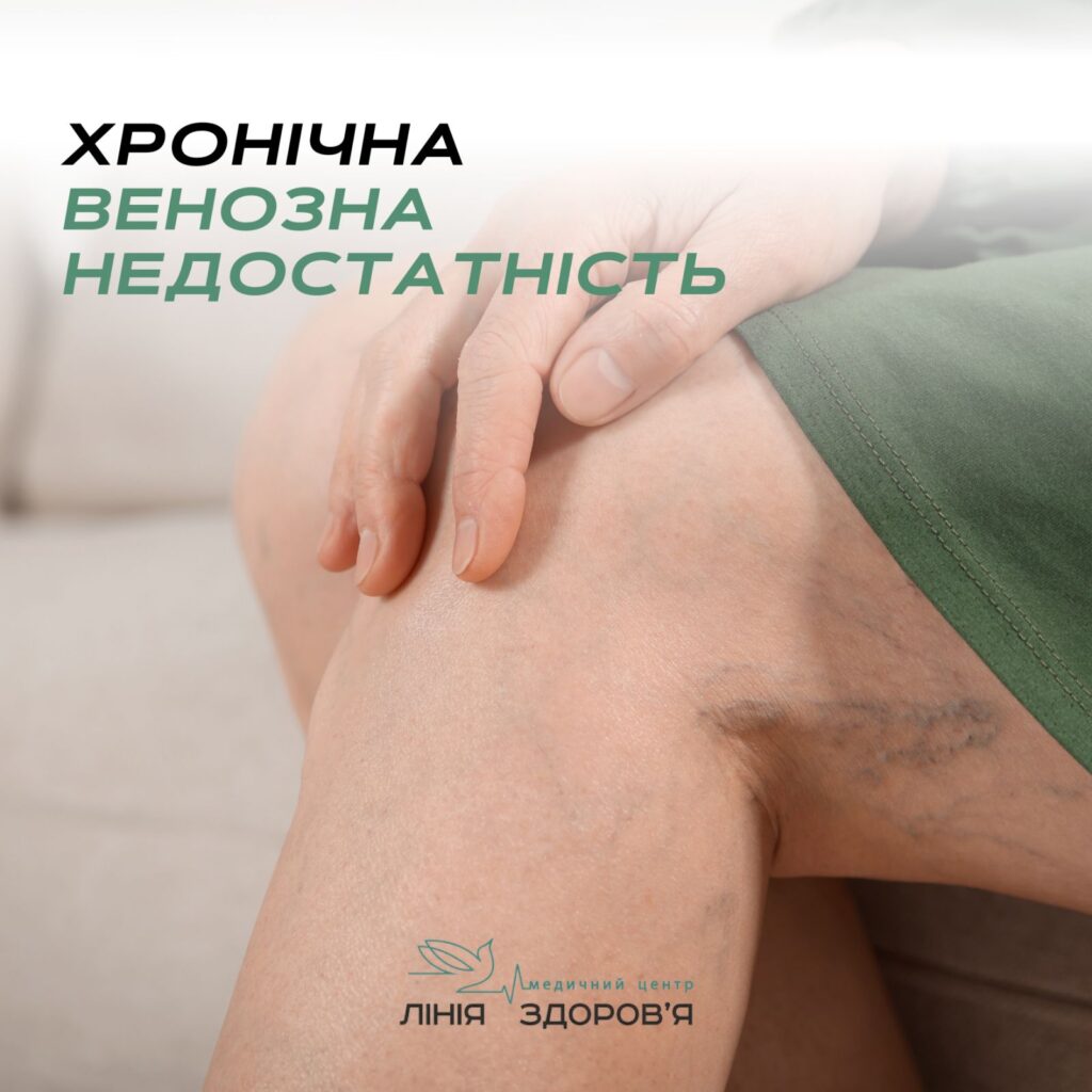 Хронічна венозна недостатність - Медичний центр "Лінія здоров'я"